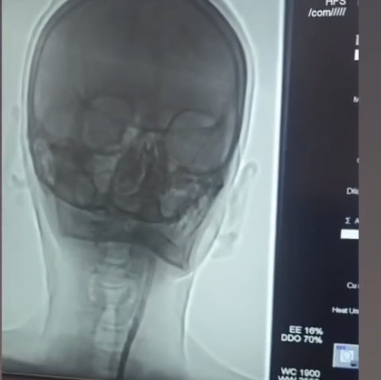 IĞDIR’DA ŞAH DAMARI DARLIĞI BULUNAN HASTAYA STENT TAKILDI. HASTA, TEDAVİSİNİN ARDINDAN TABURCU...