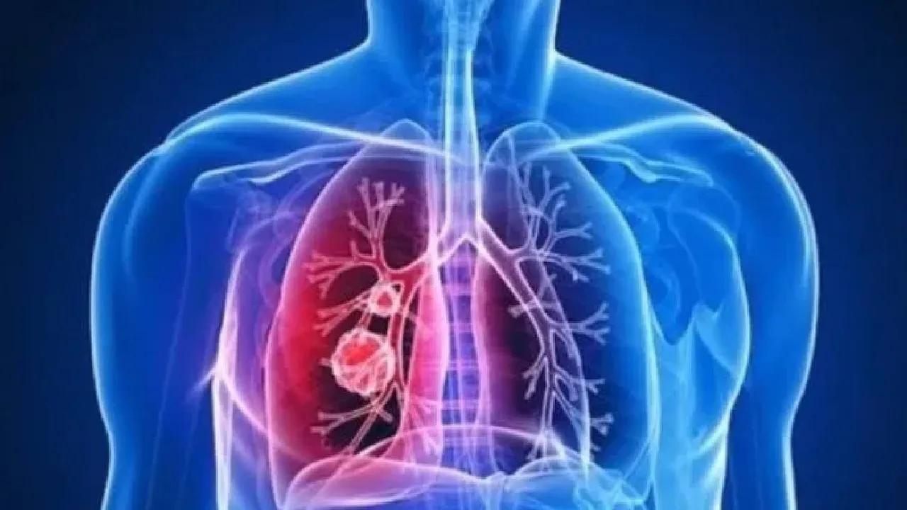Her yıl on binlerce kişi bu hastalıktan ölüyor! Akciğerlerde başlıyor: Öksürük ve nefes darlığı varsa...