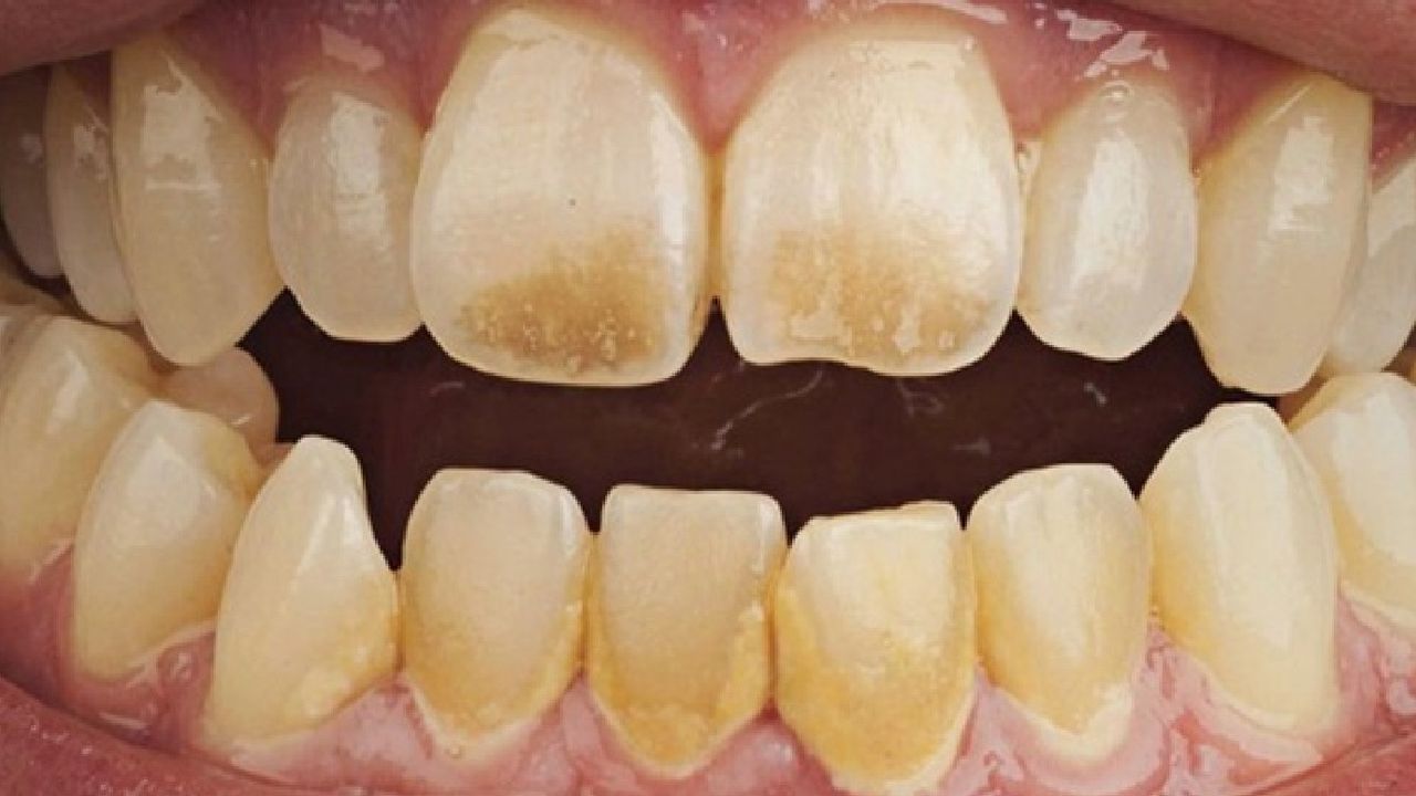 Dişlerdeki kahverengi lekeleri silgi gibi siliyor! Dişçiye gitmeden deneyin