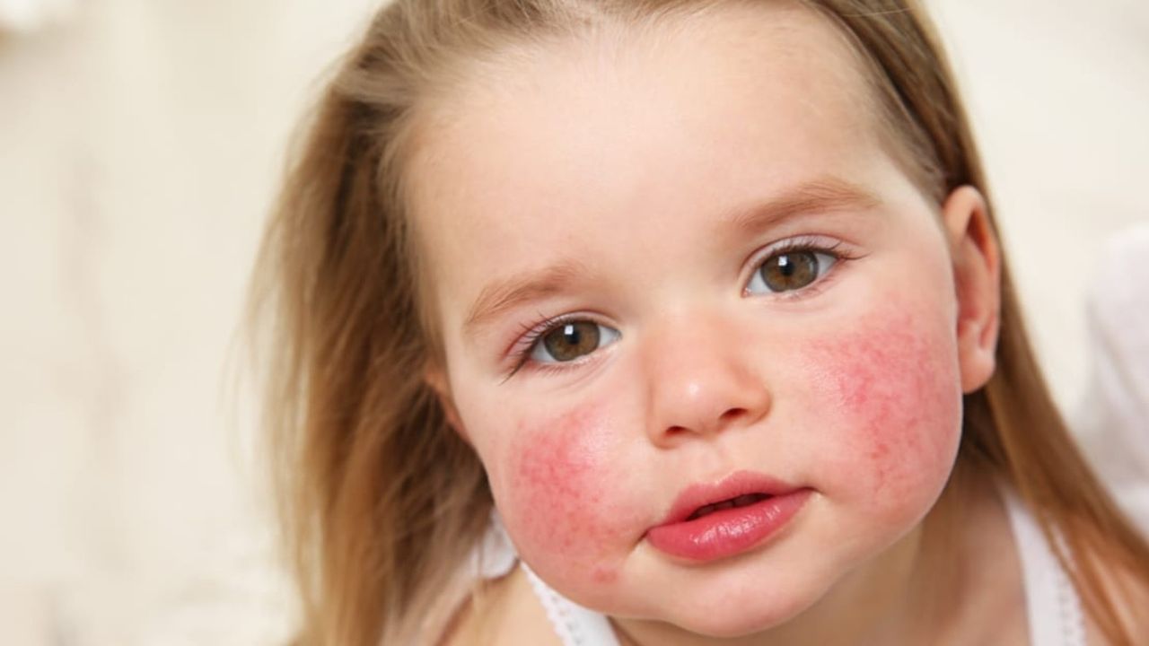 Özellikle çocukları tehdit ediyor! Uzmanlardan riskli açıklama: Yanaklarda kızarıklık ve döküntü varsa...