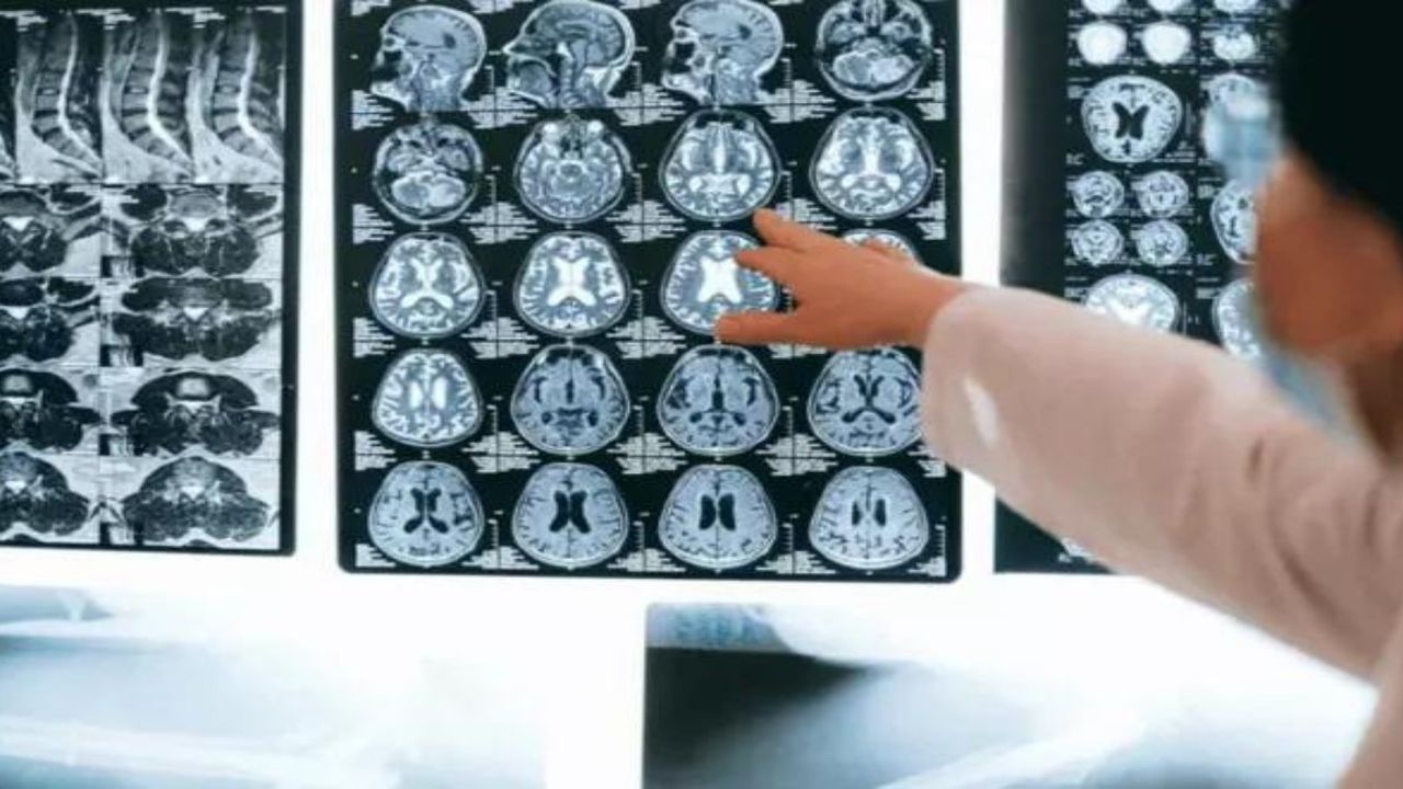 Türk cerrahın mucizevi buluşu: Beyin tümörünü ameliyatsız eritiyor! Tıp camiası şaşkın