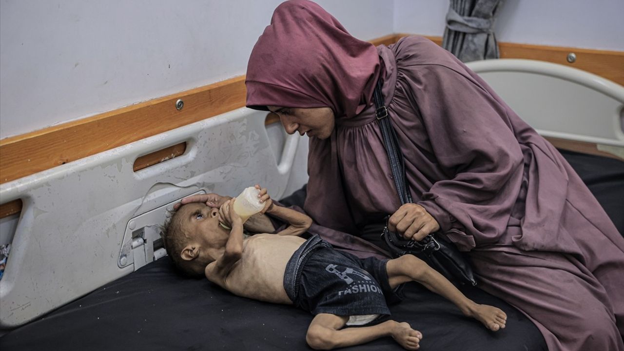 Gazze'deki Açlık Sembolu: Filistinli Bebek Muhammed'in Doktorundan Açıklama