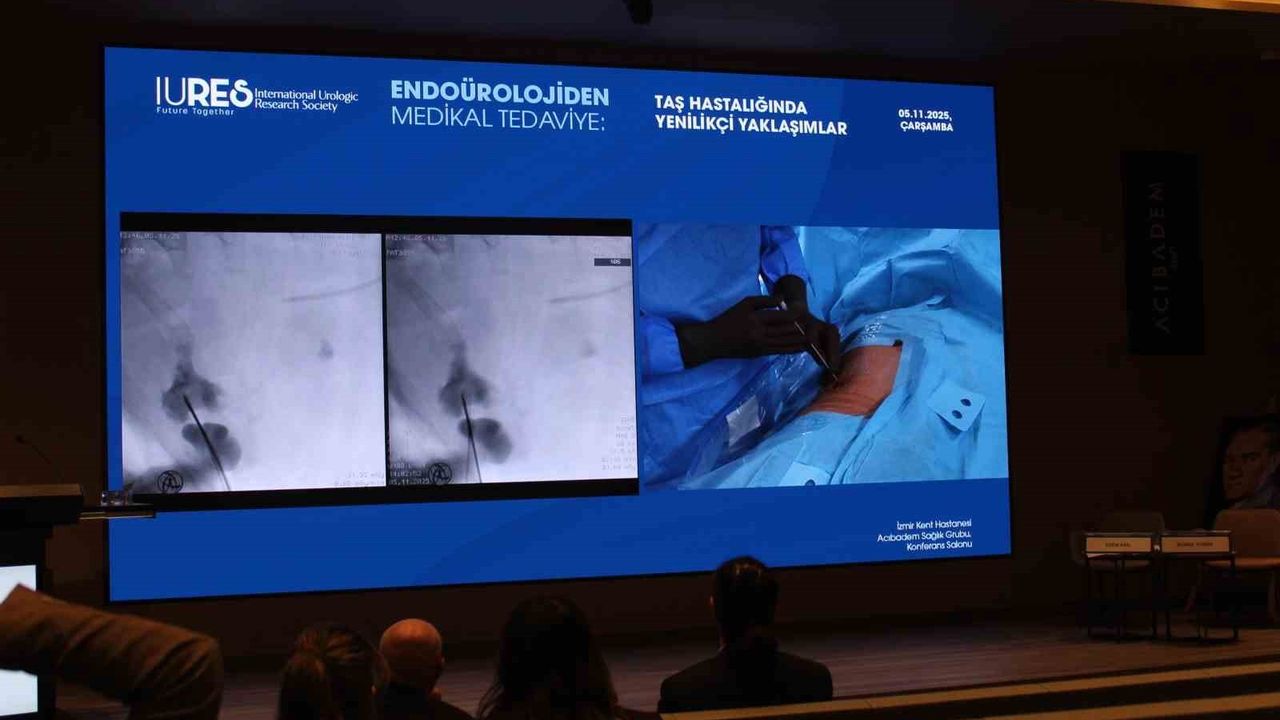 Endoüroloji Hızla Dönüşüyor: Lazer ve Robotik Öne Çıkıyor