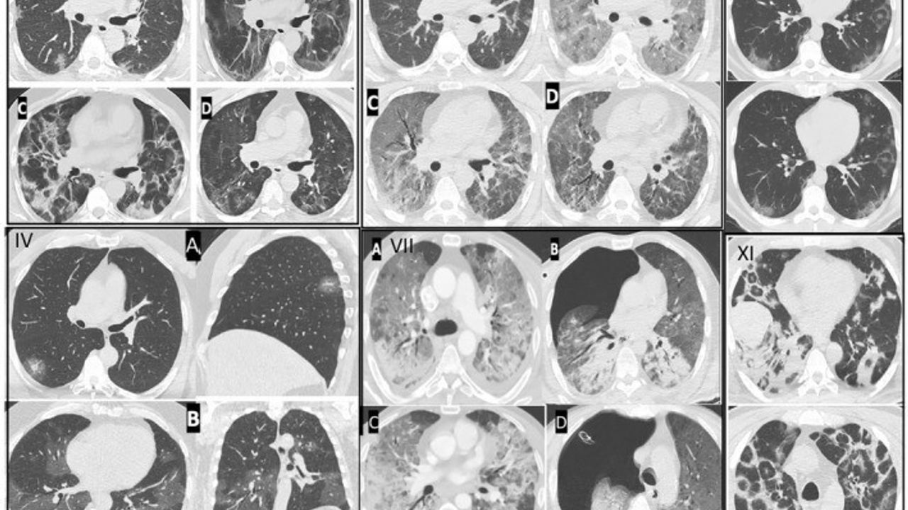 Gençlerde ani ölümler artıyor: Prof. Dr. Şevket Özkaya’dan Kovid-19 uyarısı