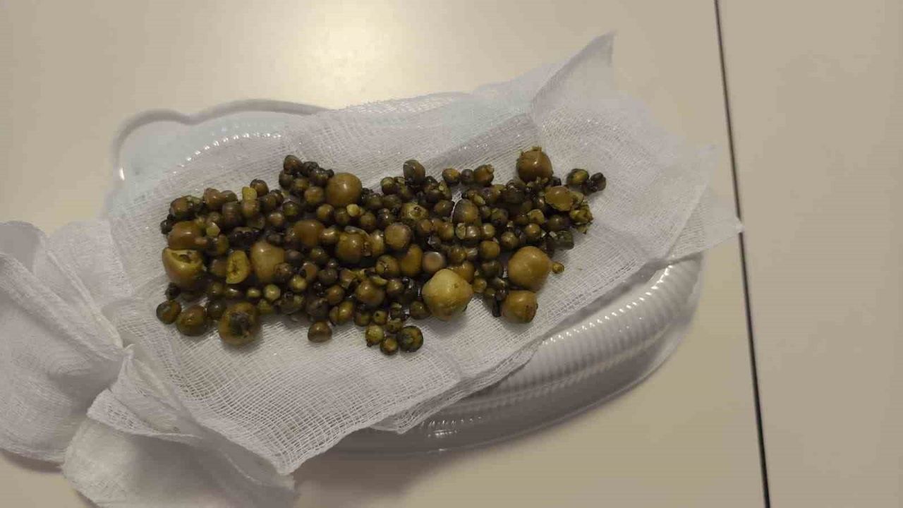 İnegöl'de 77 Yaşındaki Kadının Safra Kesesinden 213 Taş Çıkarıldı