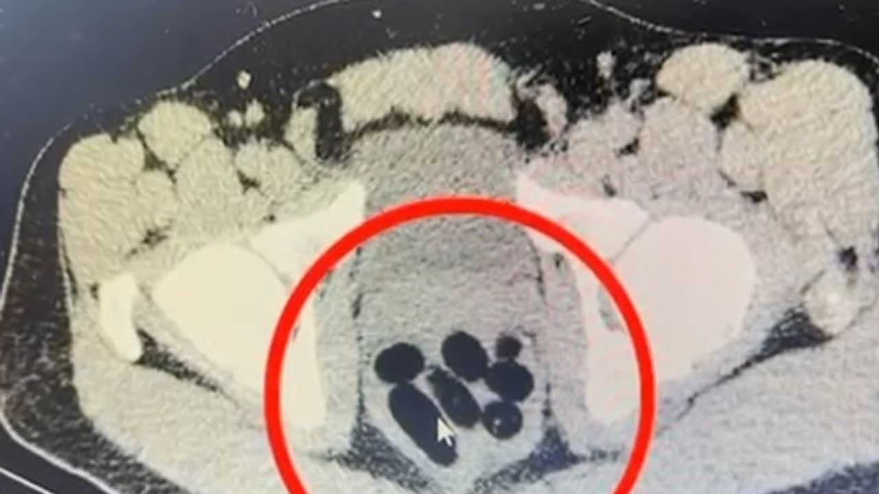 Kayseri'de Kurye Midesinden 50 Kapsül — 500 Gram Uyuşturucu Ele Geçirildi