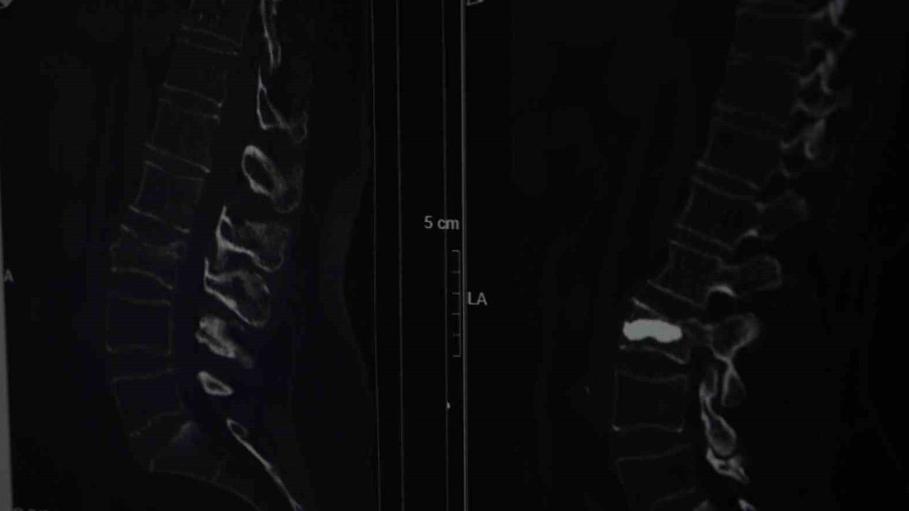 Kemik Erimesi Uyarısı: 76 Yaşındaki Hastanın Omurga Kırığı Bel Fıtığı Sanıldı