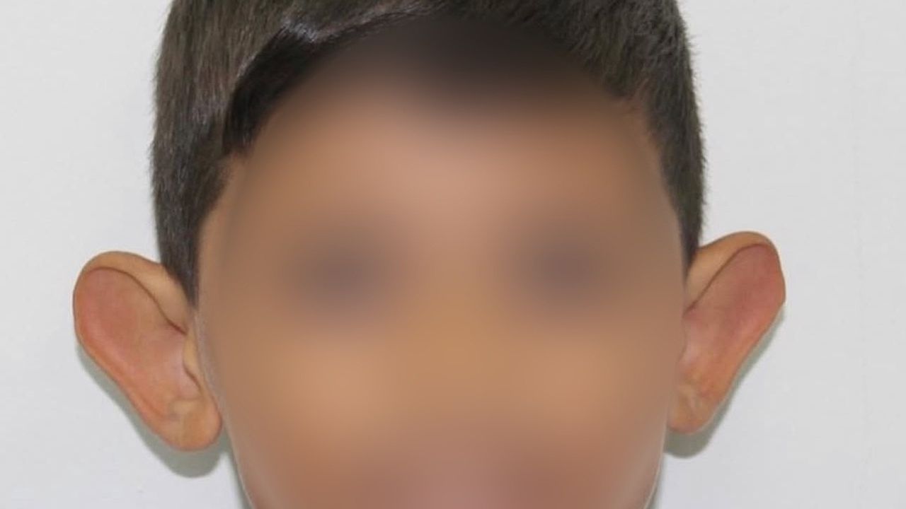 Kepçe Kulak Çocuklarda Özgüveni Zedeliyor — 6-7 Yaşında Müdahale Önemli