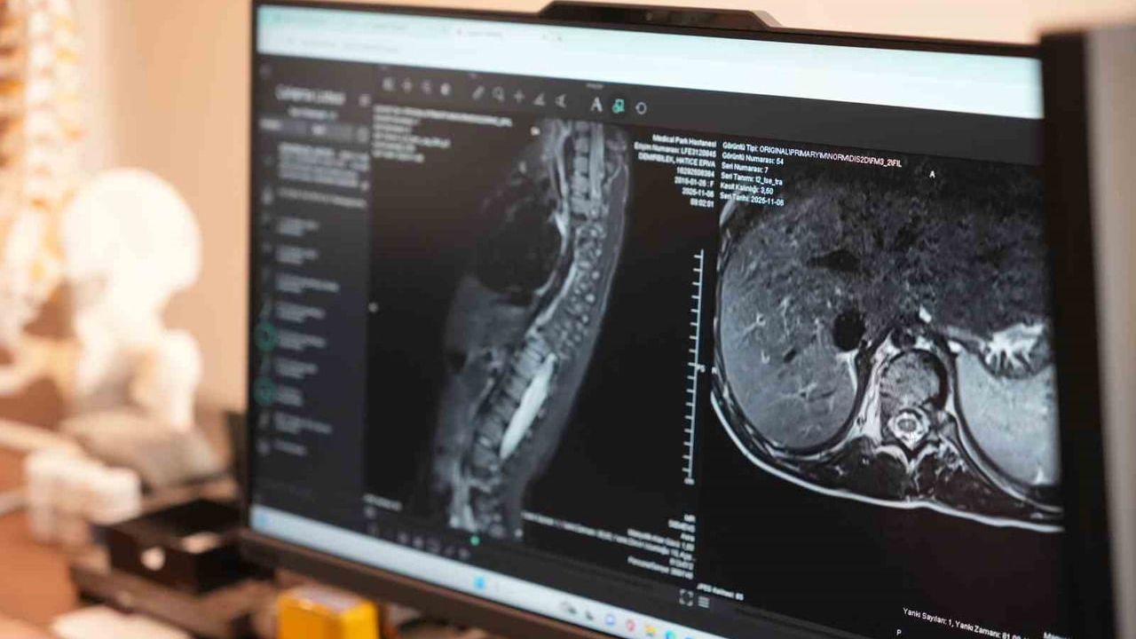 Annelerin Erken Fark Ettiği Skolyoz: Tedavi Süreci ve Kritik Eşikler