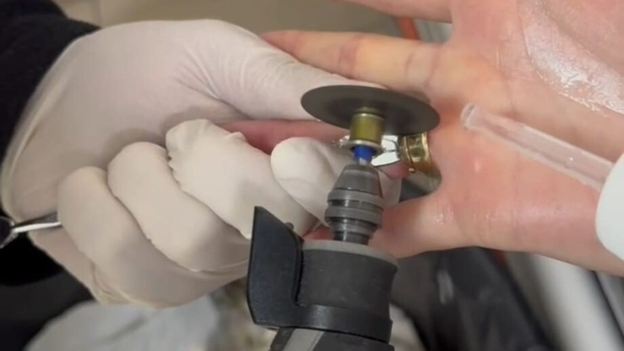 Batman’da Parmağına Sıkışan İki Yüzük İtfaiye Tarafından Spiral Makineyle Çıkarıldı