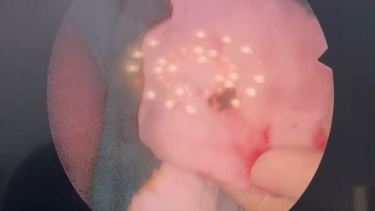 Elazığ’da Burun Estetiğinde Şaşırtan Olay: Rinolit (Burun Taşı) Çıkarıldı