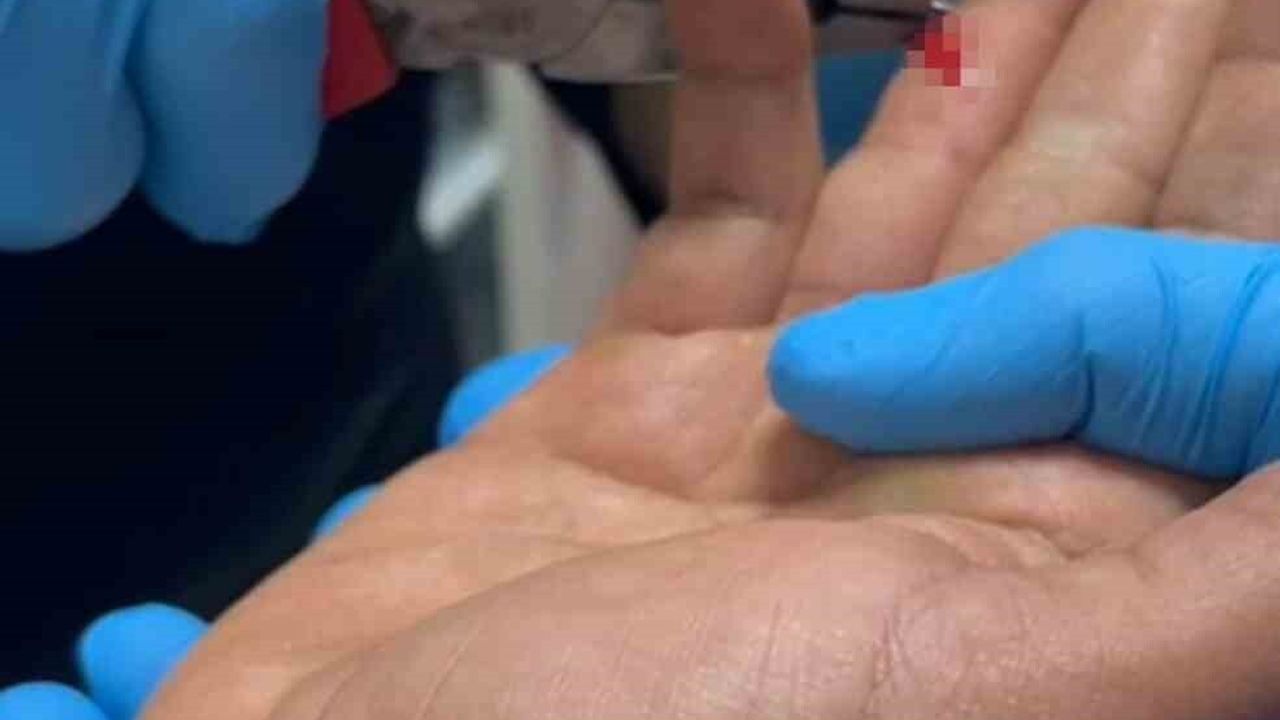 Kahta'da Balık Avı Kabusu: Parmağına Saplanan Olta İğnesini İtfaiye Çıkardı