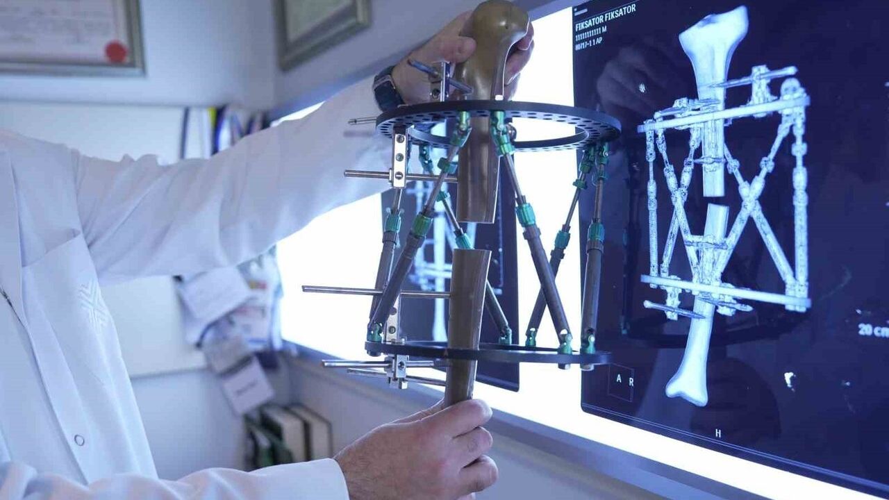 Kemik Uzatma: Boy Kısalığına Modern Çözüm — Distraksiyon Osteogenezisi