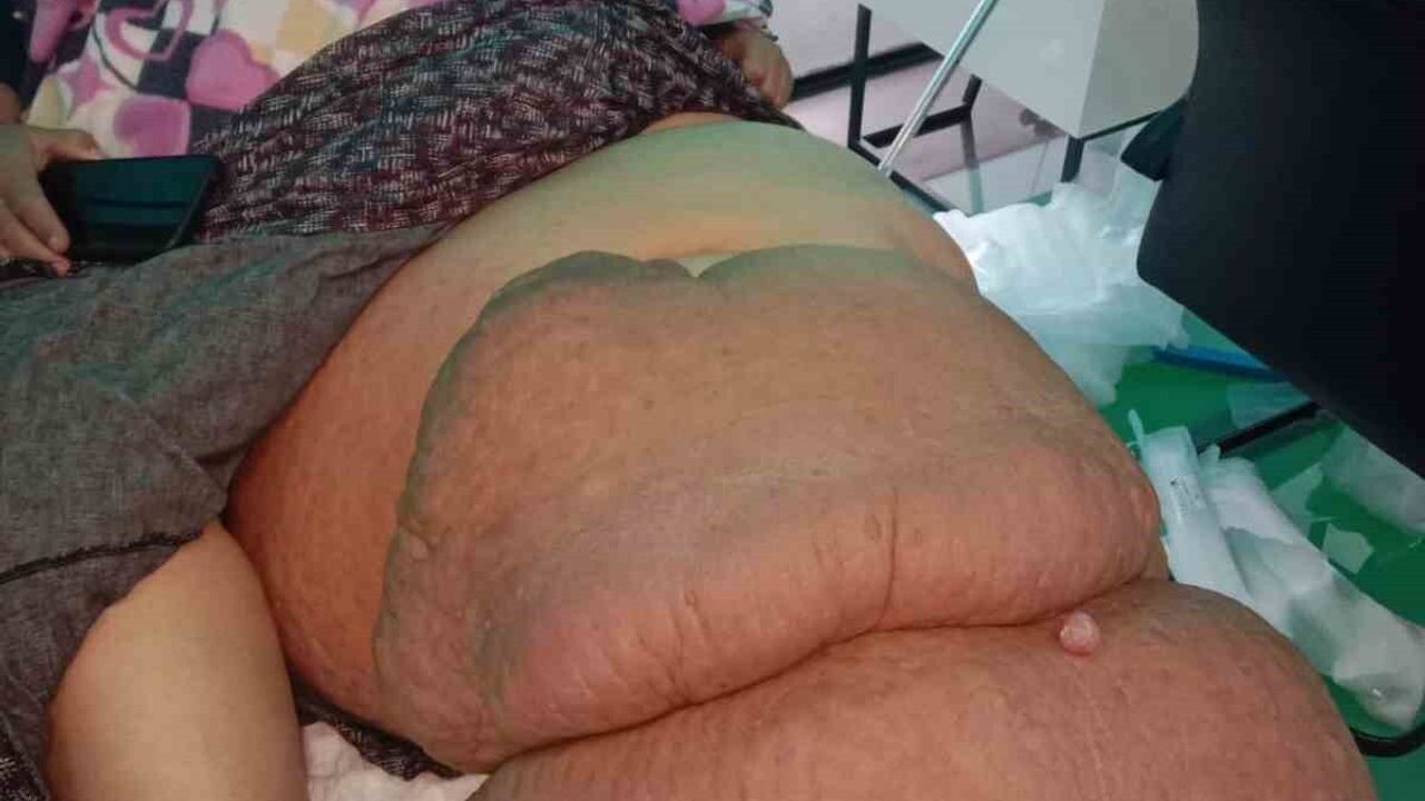 Mersin'de 35 Yıllık Fil Hastası Cennet Karabacak: Bacağı 100 kg'tan 50 kg'a Düştü, Destek Bekliyor