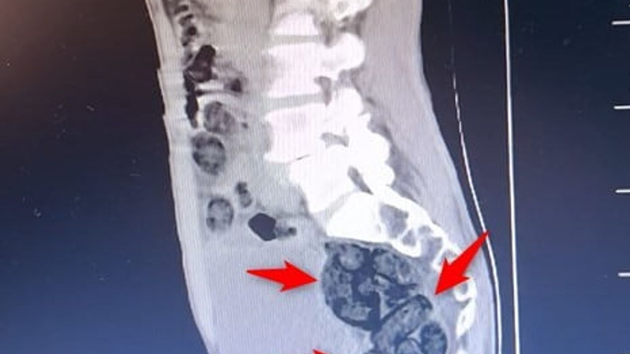 Batman'da Otobüste Yakalandı: Midesinden 64 Parça, 472 Gram Metamfetamin Çıktı