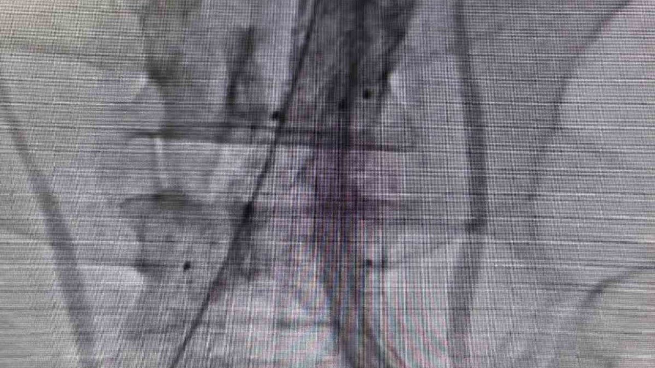 Bilecik'te Kapalı Yöntemle Hayat Kurtaran Ana Atardamar Onarımı