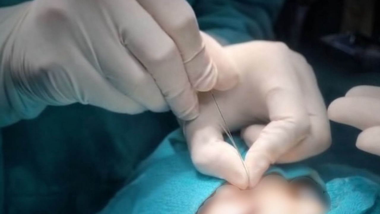 Çukurca'da Gözyaşı Kanalı Ameliyatları Başladı