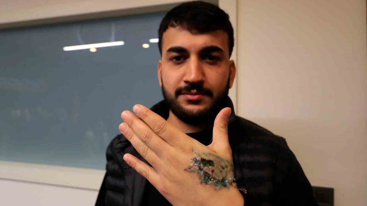 Dövme Sildirme Faciası: Yasin Taş'ın Elinde İkinci Derece Yanık, Deri Nakli Gerebilir