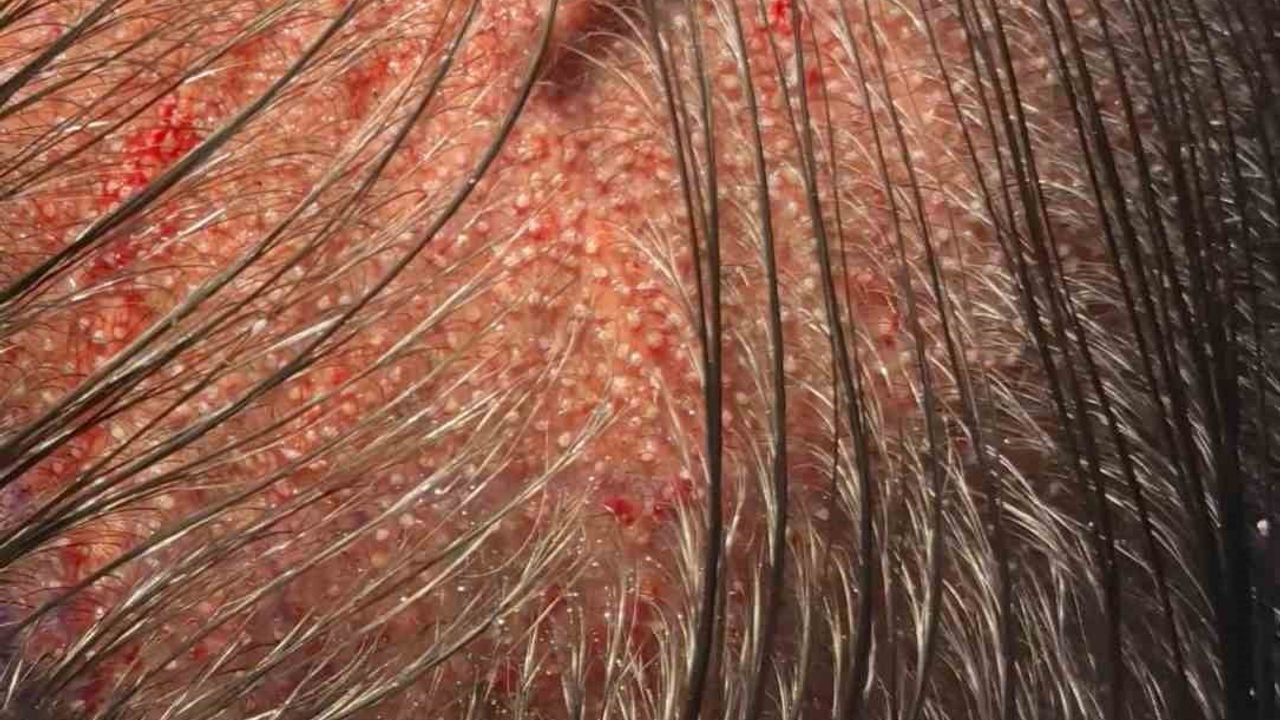 Kadınlarda Tıraşsız Saç Ekimi Mümkün: DHI Tekniği Öne Çıkıyor