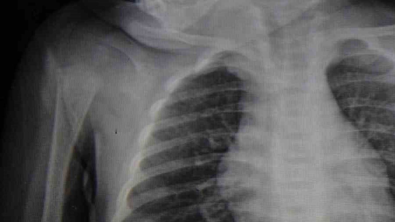 Karaman'da 6 aylık E.A.'nın boğazına kaçan kumanda pili ameliyatla çıkarıldı