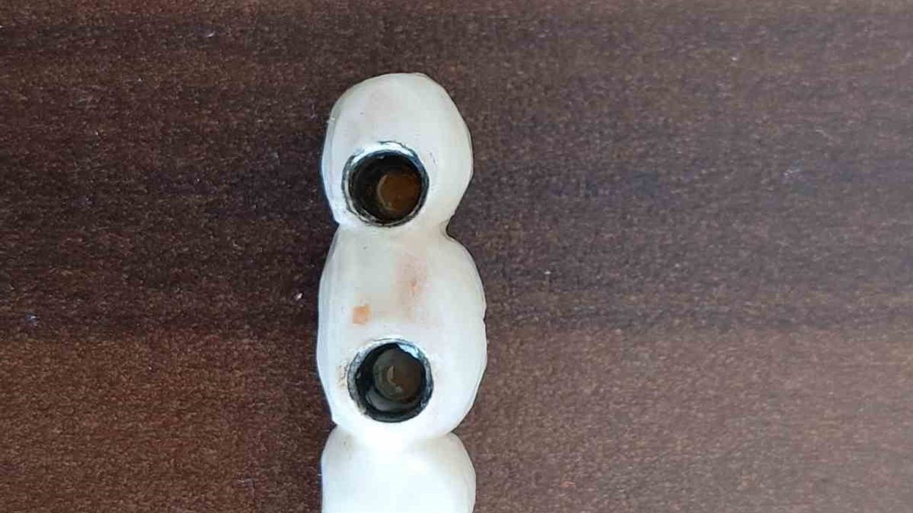 Kayseri'de implant mağduriyeti: Zemzem Korkmazer dişini elinde taşıyor