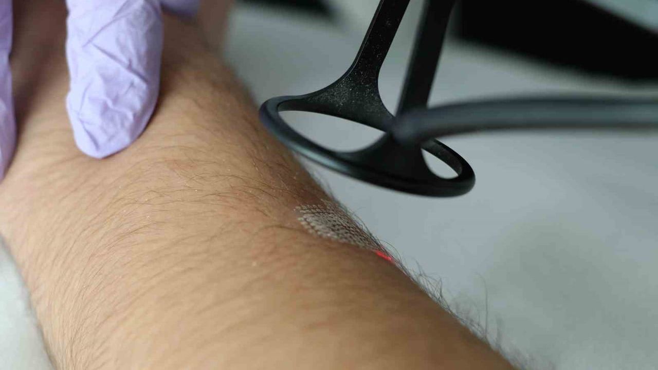 Lazer Tedavilerinde Başarıyı Artıran Mevsim: Kış Avantajı