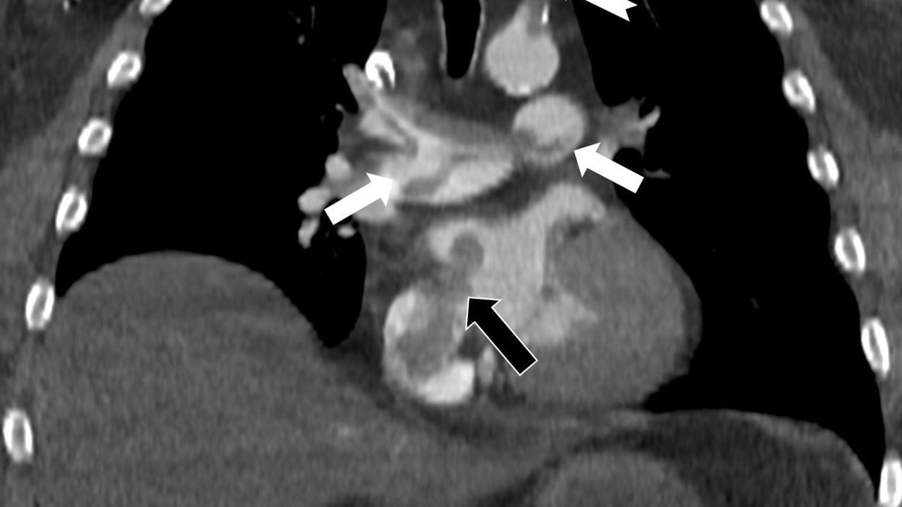 Prof. Dr. Nevzat Karabulut’tan Hayati Tespit: Kalp Deliği Paradoks Emboliye Yol Açıyor