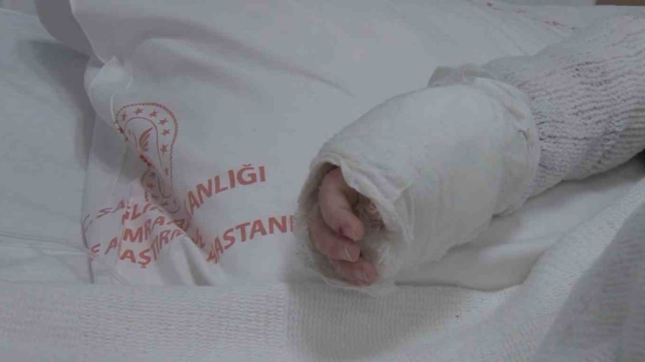 İstanbul'da 20 aylık bebek kaynar suyla yanarak vücudunun %27'si yandı
