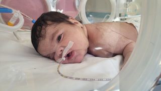 Kütahya'da Benzersiz Ameliyatla Bebeğin Boynundan 445 Gram Tümör Çıkarıldı