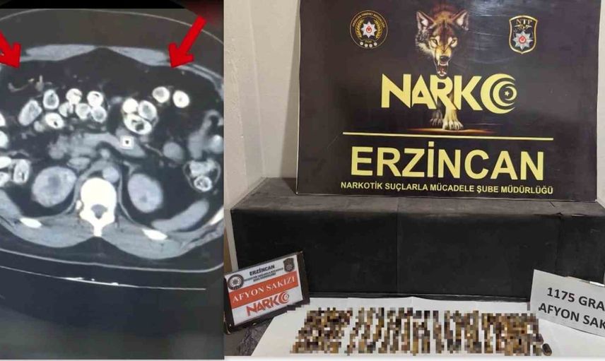 Erzincan'da bedenlerinde 287 kapsül taşıyan üç kişi tutuklandı