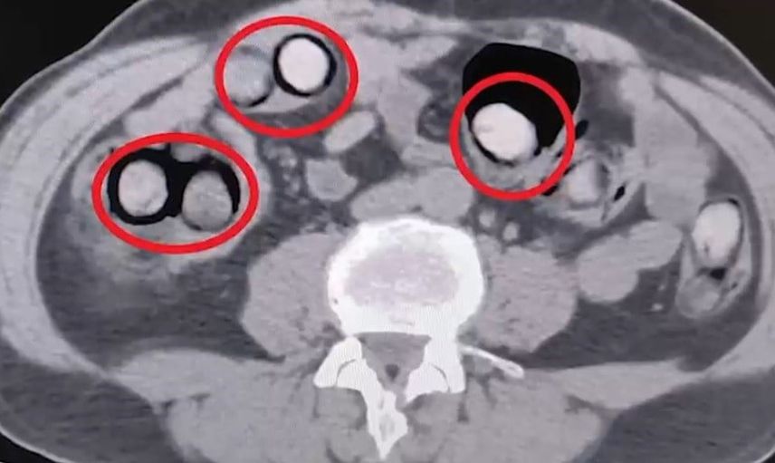 Otobüste röntgende ortaya çıktı: mide ve bağırsaklarında 758 gram metamfetamin