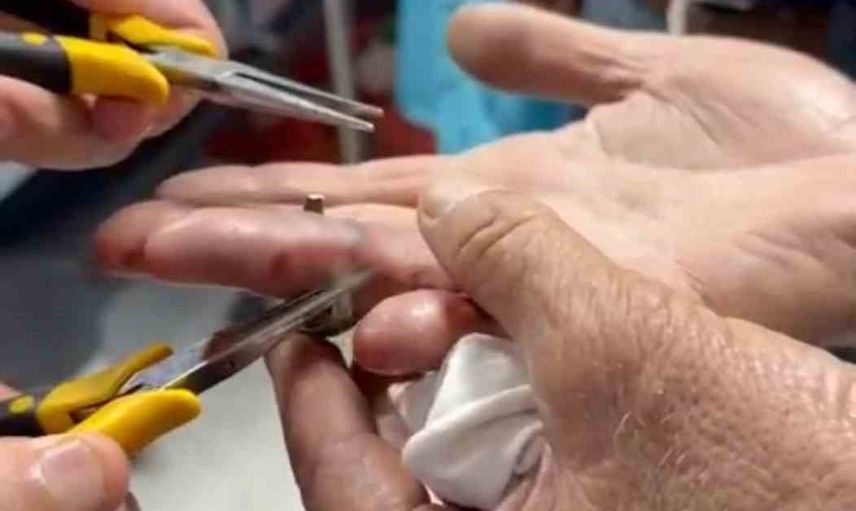 Acil serviste kontrollü müdahale: Batman’da parmağına sıkışan yüzük çıkarıldı