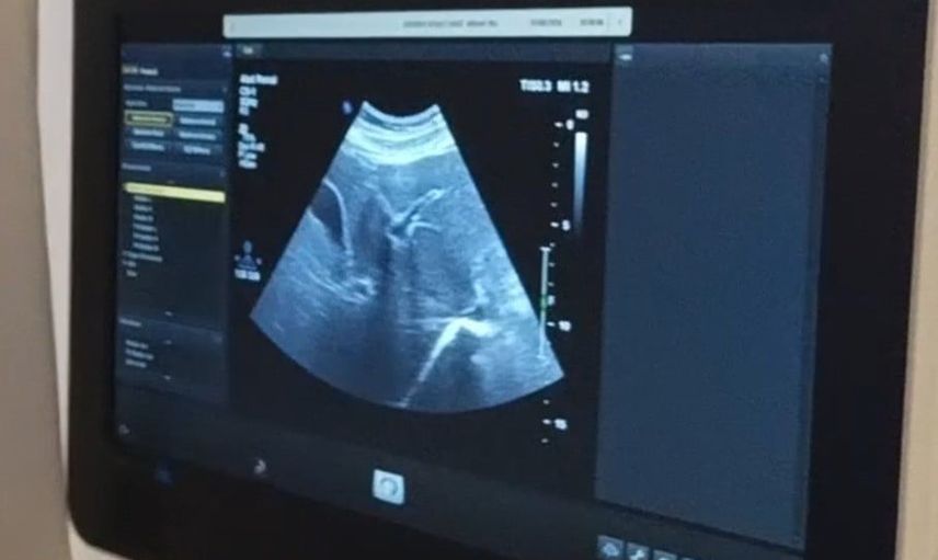 Siverek'te kronik hepatit B'li hastalara yerinde karaciğer biyopsisi imkanı
