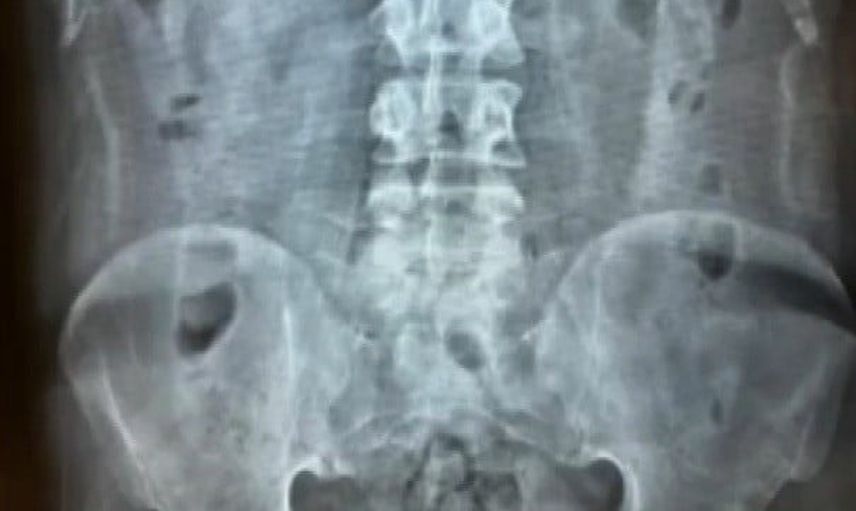 Mide ve bağırsakta 1 kilo eroinle yakalanan dört şüpheli cezaevine gönderildi