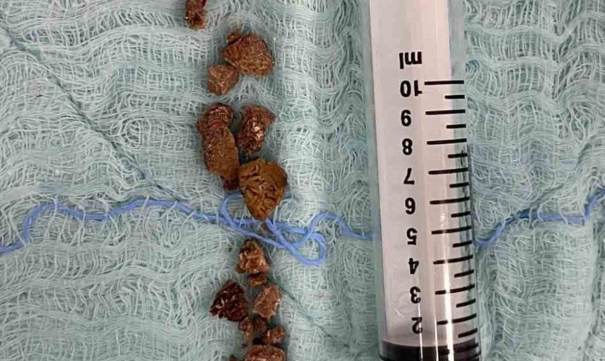 Dinar devlet hastanesinde böbrek taşlarına yönelik perkütan nefrolitotomi dönemi