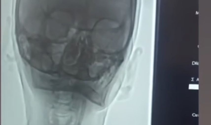 Iğdır'da karotis darlığına stentle müdahale, hasta taburcu edildi