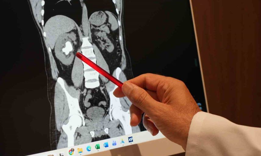 Sessiz büyüyen geyik boynuzu taşı sırtından girilerek parçalanıp çıkarıldı
