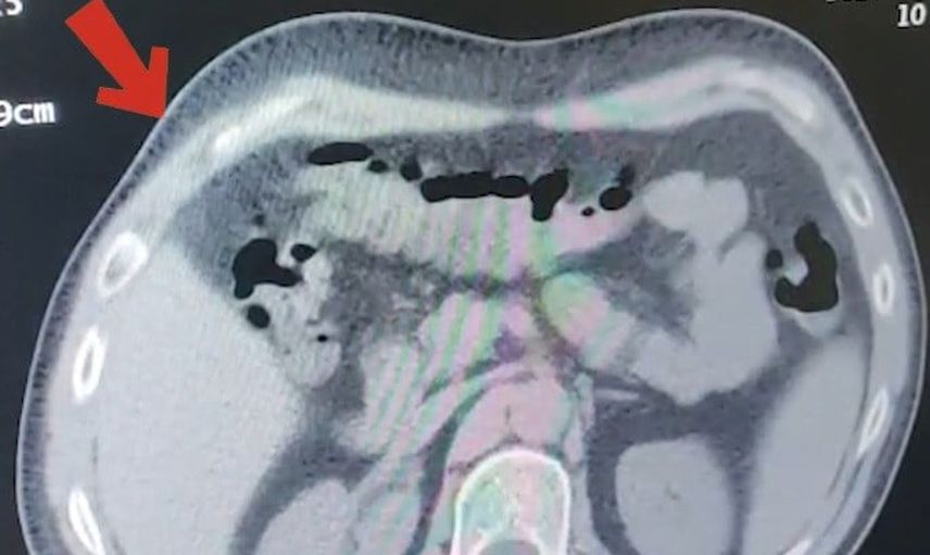 Otobüste röntgenle tespit: mide ve bağırsaklarında 608 gram metamfetamin çıktı