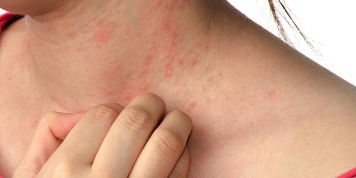 uyuz vakaları artmaya başladı