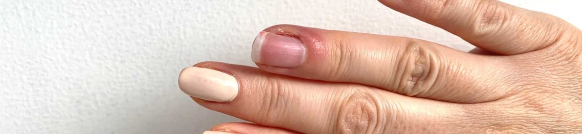 Protez Tırnak, Kalıcı Oje ve UV Işını Zararları: Önleme ve Tedavi Yöntemleri