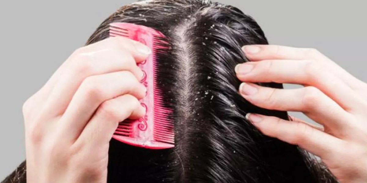 kepek sorunu nasıl çözülür