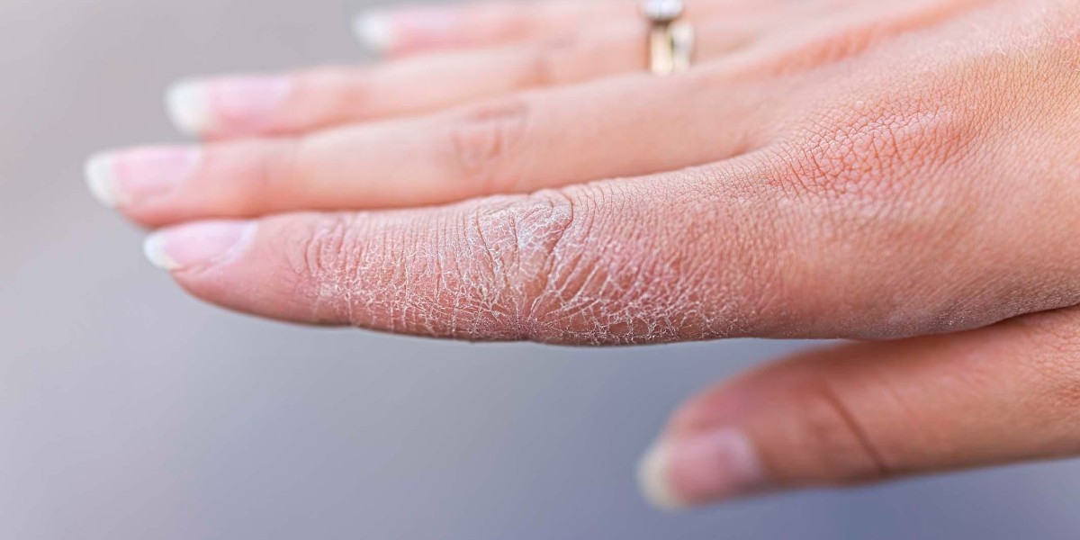 kuru ve çatlak ellere kesin çözüm