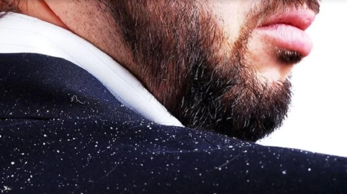 Saç dökülmesine İbn-i Sina kürü