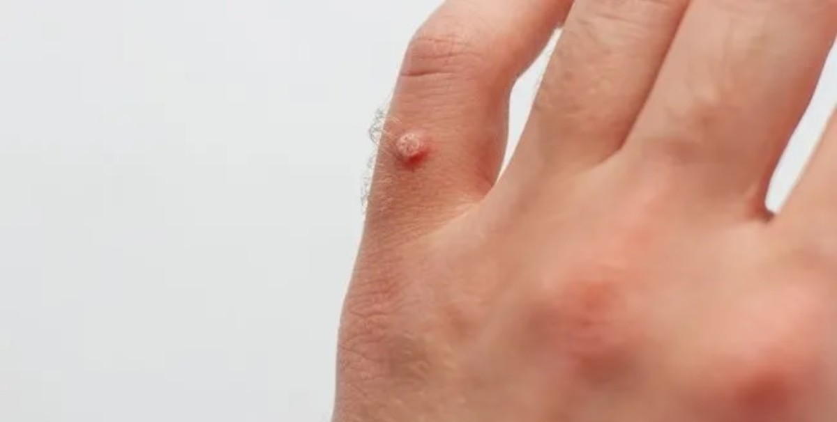 siğilleri gidermenin formülü