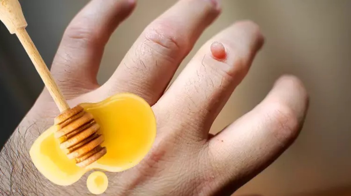 siğilleri gidermenin formülü