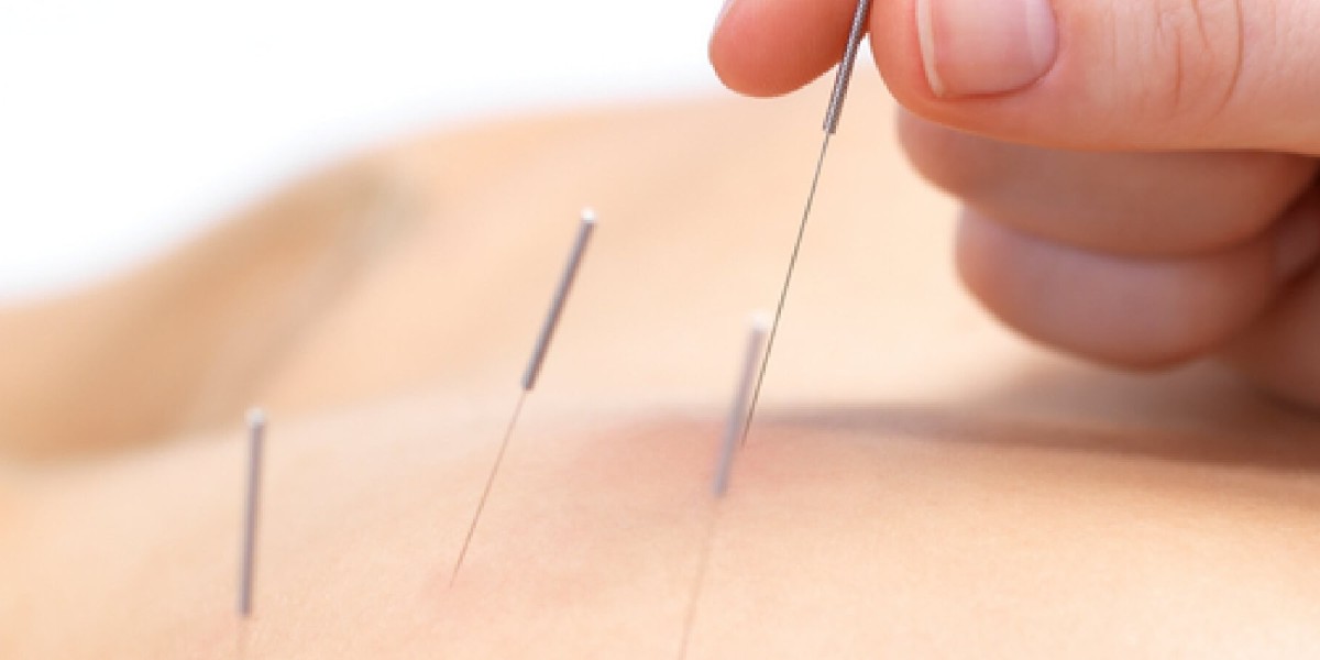 AKUPUNKTUR