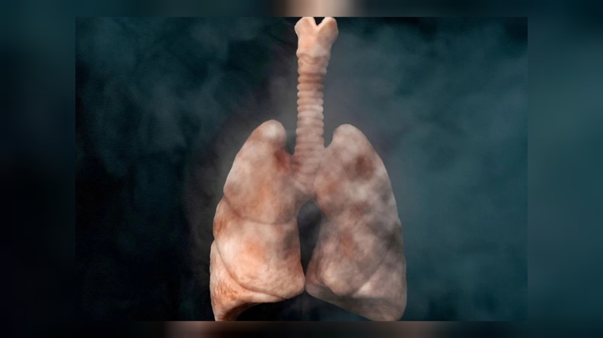 İŞTE AKCİĞER KANSERİNİ ÖNLEYEBİLECEK O YÖNTEMLER