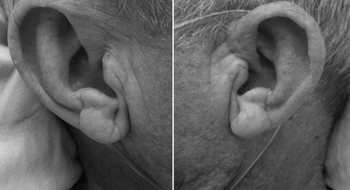 Kalp krizi geçirip geçirmeyeceğinizi kulak testiyle öğrenin