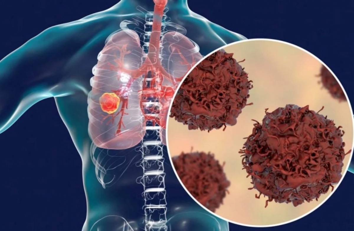 TÜRKİYE'DE ERKEKLERDE KADINLARA GÖRE 3.5 KAT DAHA FAZLA GÖRÜLME