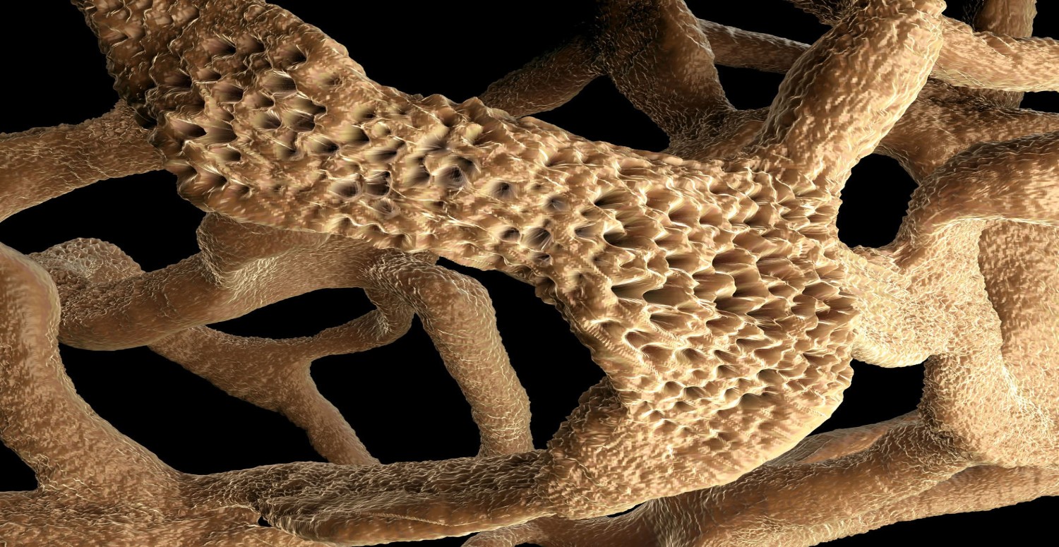 kadınlarda kemik erimesi